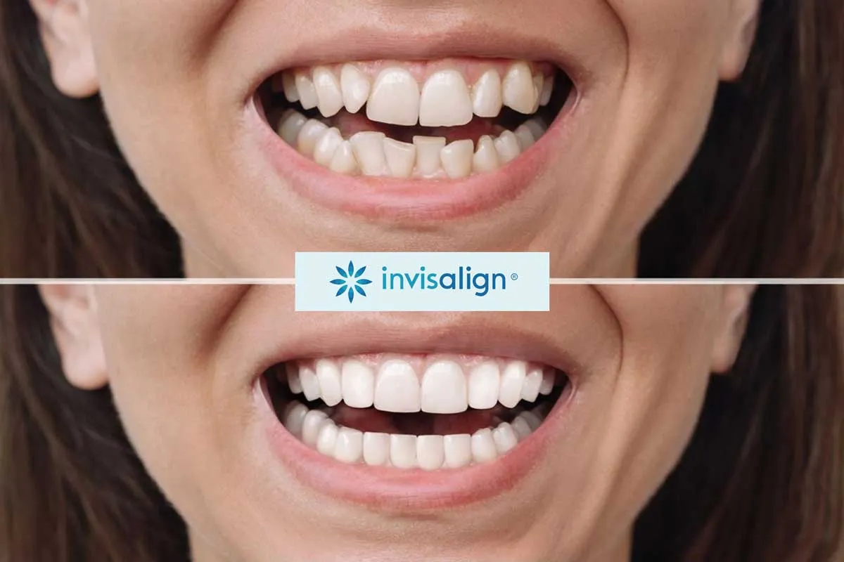 invisalign-before-and-after-photos